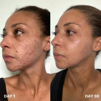 Solin Clear Skin Support