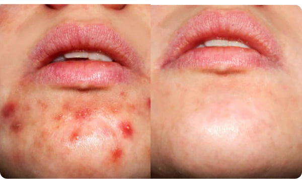 Solin Clear Skin Support